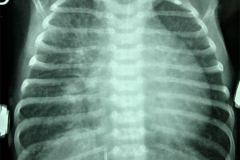 taquipnea-transitoria-edema-pulmonar-cisuritis-000