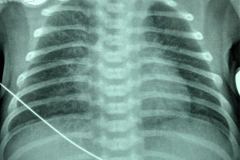 taquipnea-transitoria-pulmon-humedo-cisuritis-1996-001