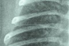 taquipnea-transitoria-pulmon-humedo-cisuritis-1996-002