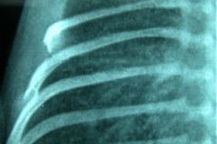 taquipnea-transitoria-pulmon-humedo-edema-pulmonar-cisuritis-der-2004-001