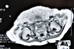 teratoma-abdominal-rnm-2000-000