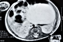 teratoma-abdominal-rnm-2000-001