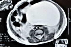 teratoma-abdominal-rnm-2000-002