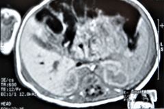 teratoma-abdominal-rnm-2000-005