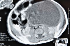 teratoma-abdominal-rnm-2000-009