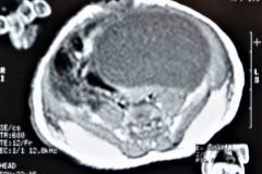 teratoma-abdominal-rnm-2000-010