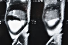 teratoma-abdominal-rnm-2000-013
