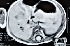 teratoma-abdominal-rnm-2000-014