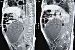 teratoma-abdominal-rnm-2000-018