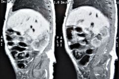 teratoma-abdominal-rnm-2000-020