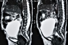 teratoma-abdominal-rnm-2000-022
