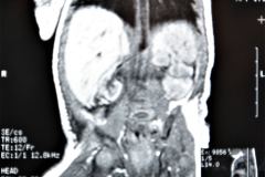 teratoma-abdominal-rnm-2000-024