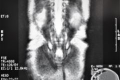 teratoma-abdominal-rnm-2000-026
