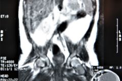 teratoma-abdominal-rnm-2000-032