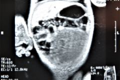 teratoma-abdominal-rnm-2000-037