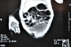 teratoma-abdominal-rnm-2000-040