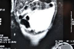 teratoma-abdominal-rnm-2000-042