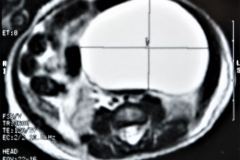 teratoma-abdominal-rnm-2000-045