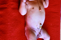 teratoma-torax-anterior-fistula-tiroglosa-1985-005