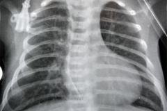 tetralogia-de-fallot-silueta-cardiaca-en-forma-de-bota-o-zueco-2004-000