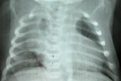timo-imagen-cardiotimica-normal-neumomediatino-1988-000