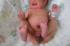 torcion-testicular-der-6d-2005-000