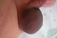 torcion-testicular-der-6d-2005-002