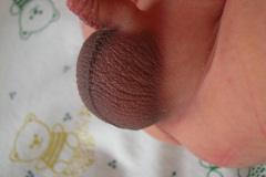 torcion-testicular-der-6d-2005-003