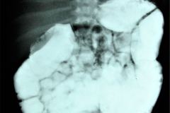 transito-intestinal-normal-1982-000