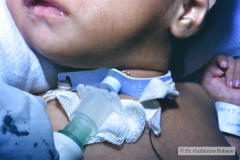 traqueostomia-canula-y-ventilacion-mecanica-1999-002