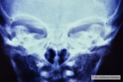 trauma-fractura-malar-der-equimosis-escoriacion-palpebral-1993-000