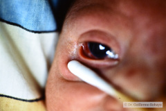 trauma-hemorragia-subconjuntival-der-herida-palpebral-izq-1987-000