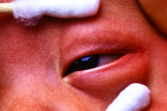 treacher-collins-franceschetti-zwalen-klein-disostosis-mandibulofacial-1986-006