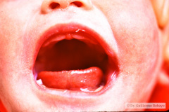 treacher-collins-franceschetti-zwalen-klein-disostosis-mandibulofacial-1986-007