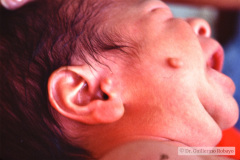 treacher-collins-franceschetti-zwalen-klein-disostosis-mandibulofacial-1987-001