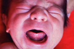 treacher-collins-franceschetti-zwalen-klein-disostosis-mandibulofacial-1987-002