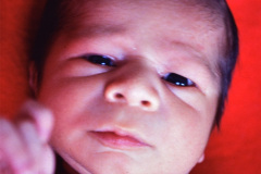 treacher-collins-franceschetti-zwalen-klein-disostosis-mandibulofacial-1987-003