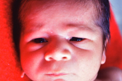treacher-collins-franceschetti-zwalen-klein-disostosis-mandibulofacial-1987-004