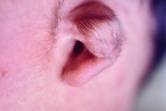 treacher-collins-franceschetti-zwalen-klein-disostosis-mandibulofacial-fisura-facial-transversa-000
