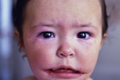 treacher-collins-franceschetti-zwalen-klein-disostosis-mandibulofacial-fisura-tipo-7-tessier-1a-1993-000
