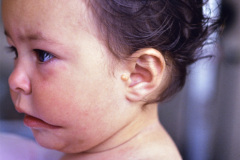treacher-collins-franceschetti-zwalen-klein-disostosis-mandibulofacial-fisura-tipo-7-tessier-1a-1993-001