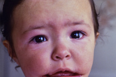 treacher-collins-franceschetti-zwalen-klein-disostosis-mandibulofacial-fisura-tipo-7-tessier-1a-1993-005