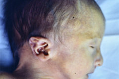 trisomia-18-edwards-1985-001