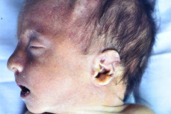 trisomia-18-edwards-1985-008