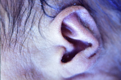 trisomia-18-edwards-anotia-mano-trisomica-1985-000