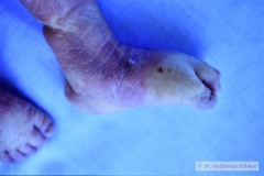 trisomia-18-edwards-anotia-mano-trisomica-1985-009