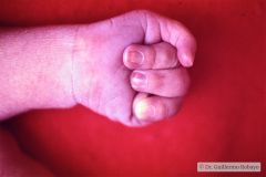 trisomia-18-edwards-dedos-mano-superpuestos-mano-trisomica-equinovaro-1991-003