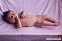 trisomia-18-edwards-dedos-mano-superpuestos-mano-trisomica-equinovaro-3m-1992-003
