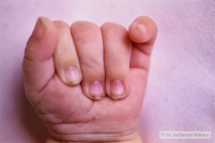 trisomia-18-edwards-dedos-mano-superpuestos-mano-trisomica-equinovaro-3m-1992-005
