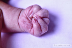 trisomia-18-edwards-mano-trisomica-mar-anoplastia-1m-13d-1992-000